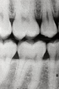 Dentophobia - Fear of Dentists